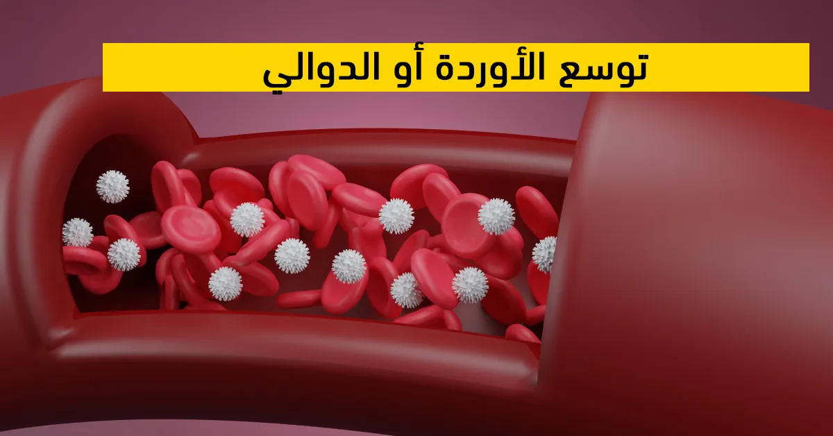 توسع الأوردة أو الدوالي  